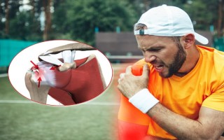 Viêm Gân Chóp Xoay Vai: Căn Bệnh Cơ Xương Khớp Đang Gõ Cửa Người Trẻ